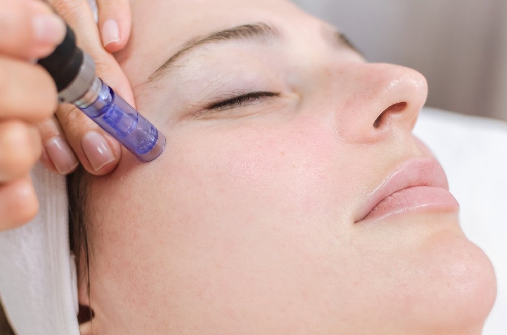 Microneedling With PRP - SkinLab USA